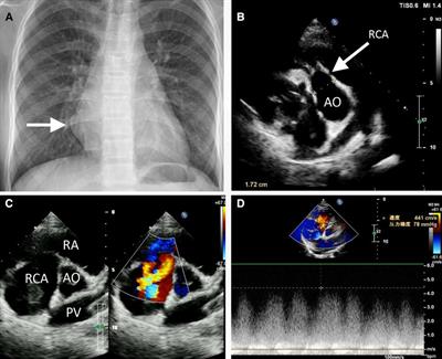 Case report: Surgical management of a rare right coronary artery fistula with a giant pseudoaneurysm compressing the pulmonary vein in a young patient